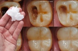 Este es el Remedio que ningún Dentista quiere que Descubras