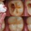 Este es el Remedio que ningún Dentista quiere que Descubras