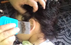 Niño infestado de piojos | ¡¡¡INCREIBLE!!!