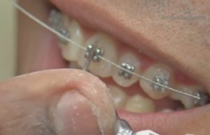 Una moda peligrosa pone en riesgo la salud de miles de jóvenes